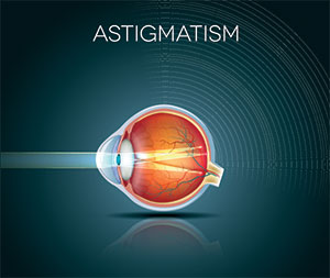 Astigmatism: causes, symptoms and treatments, Assil Eye Institute Los Angeles