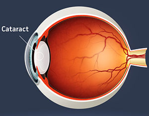 Cataract Eye Surgery, Assil Eye Institute