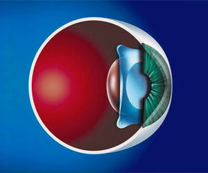 Implantable Contact Lenses