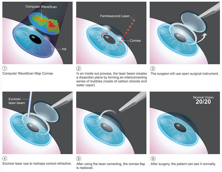 The basics of LASIK